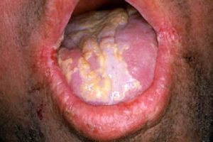 Candidas Infection