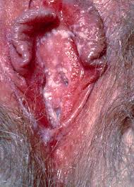 Yeast Infection