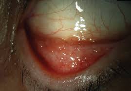 Chlamydia Conjuntivitis
