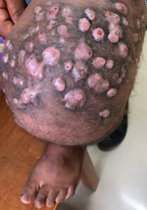 Fungal Infection