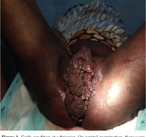 Vaginal Warts