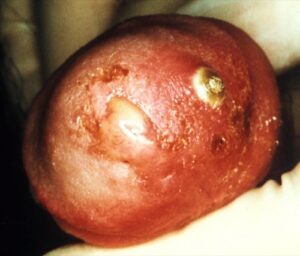 Gonorrhea