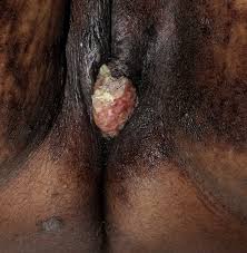 Herpes Vegetans of the Vulva
