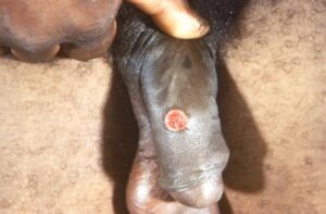 Syphilis Infected Penis