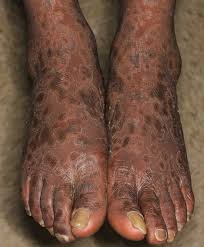 Syphilis